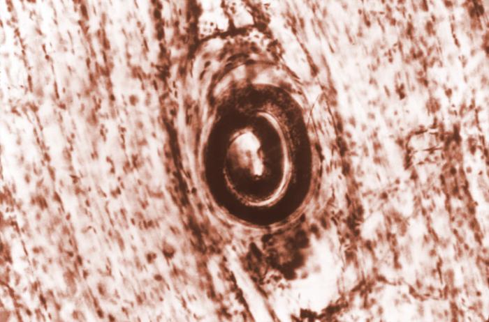 Quiste de Trichinella spiralis. CDC Public Health Library (PHIL).