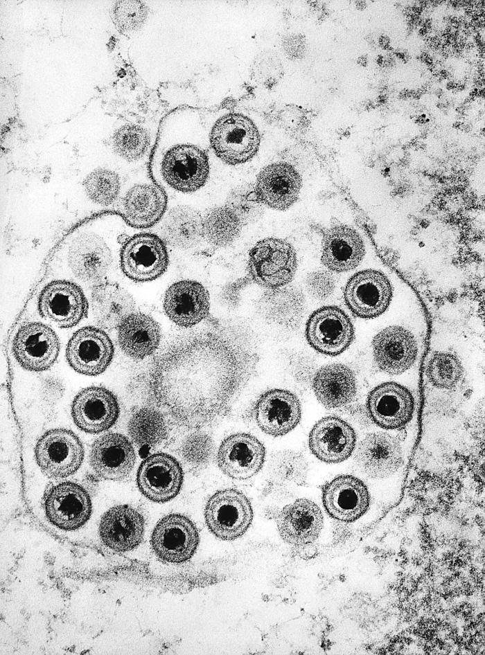 Viriones de virus del herpes. CDC Public Health Image Library (PHIL).