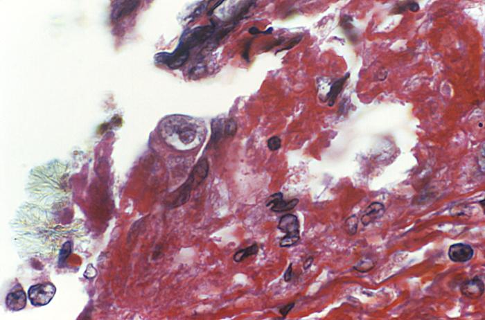 A. polyphaga en espécimen corneal humano. CDC Public Health Image Library (PHIL).