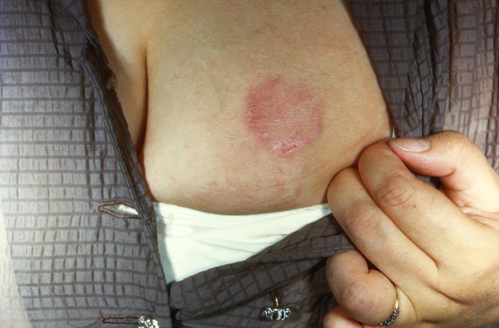 Lesión de Trichophyton mentagrophytes.  CDC Public Health Image Library (PHI