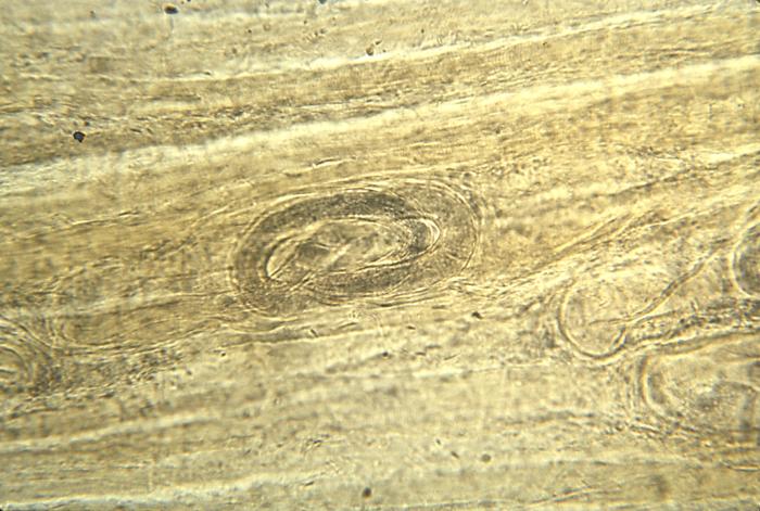 Quiste de Trichinella sp. CDC Public Health Image Library (PHIL).