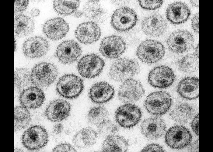 Virus de inmunodeficiencia humana 1 .CDC Public Health Image Library (PHIL). 