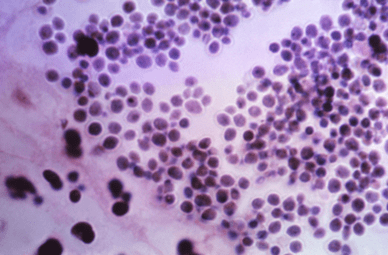 C. glabrata en muestra de tejido renal humano. CDC Public Health Image Library (PHIL).