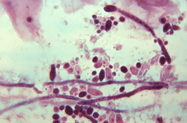 Candida spp. CDC Public Health Image Library (PHIL).