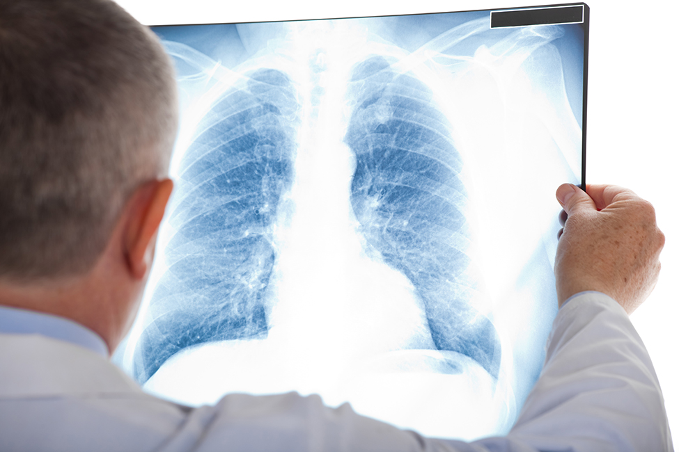 Imagen. Análisis de una radiografía de pulmón