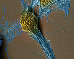  Imagen de una célula deteriorada por cáncer 