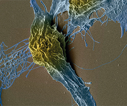  Imagen de una célula deteriorada por cáncer 